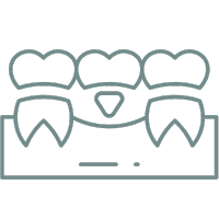 dental bridges 